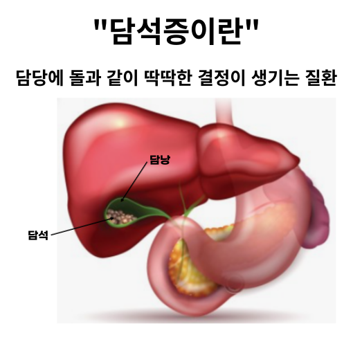 담석증이란
