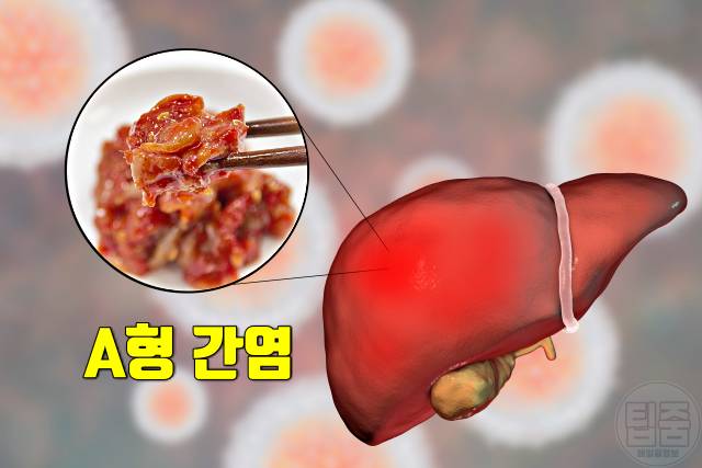 뇌경색 여름철 질병 여름질병 a형간염