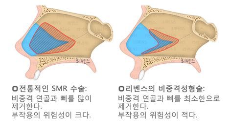 비중격만곡증수술