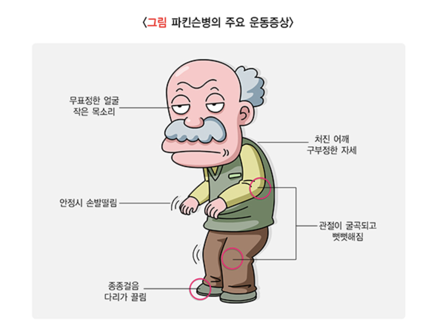 파킨슨병의 주요 증상