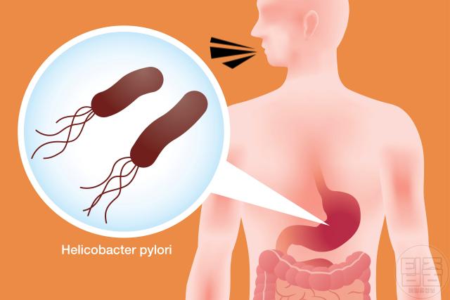 위염 증상 트림