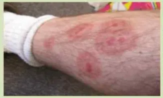 빈대 퇴치제 빈대 물린 자국