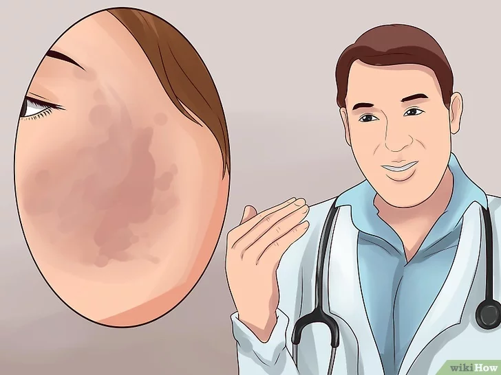 기미 잡티 제거