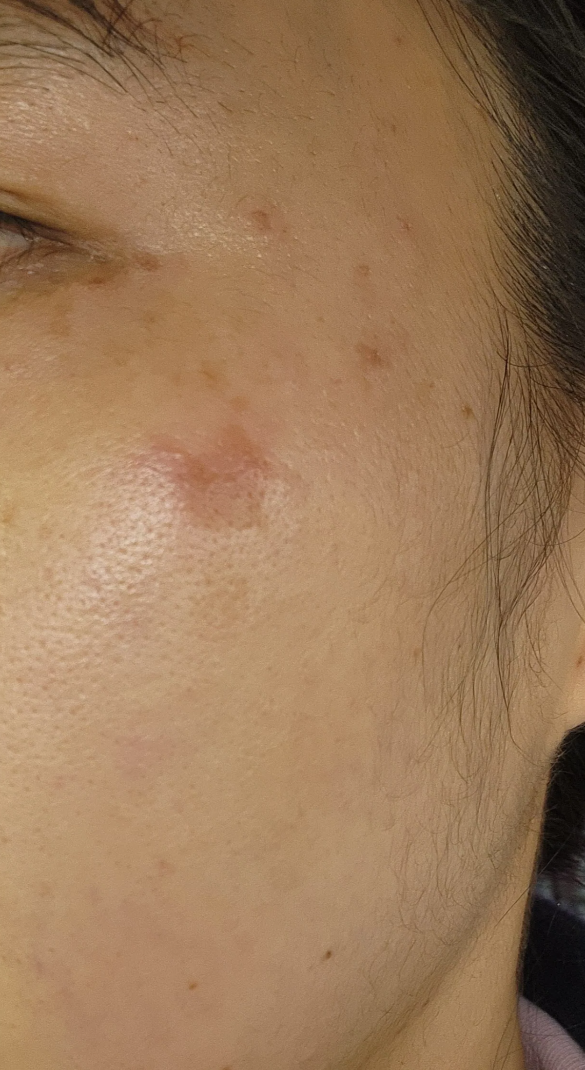 레이저시술후 사진