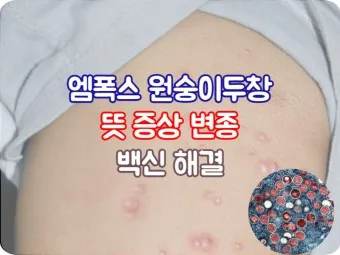엠폭스 증상 예방접종 대처법 치료방법_28