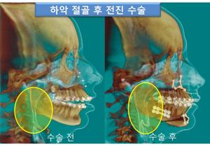 코골이 수술