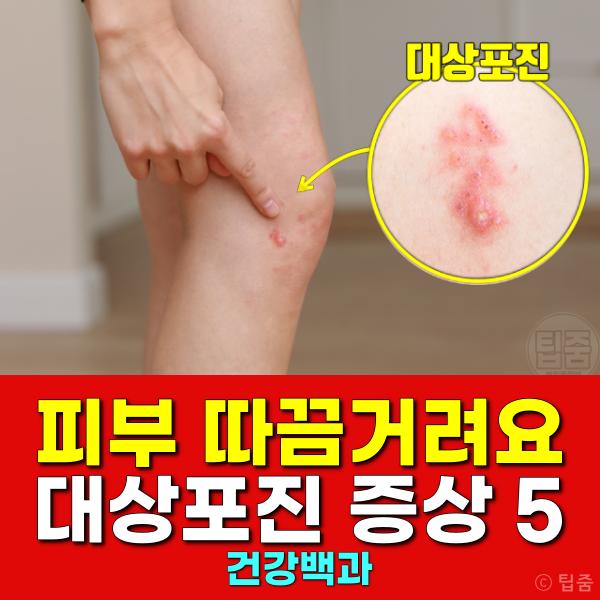 피부 따끔거림 대상포진 증상