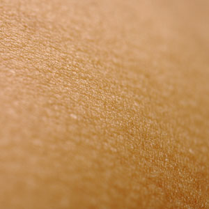 건선 초기 증상 - 단순 건조