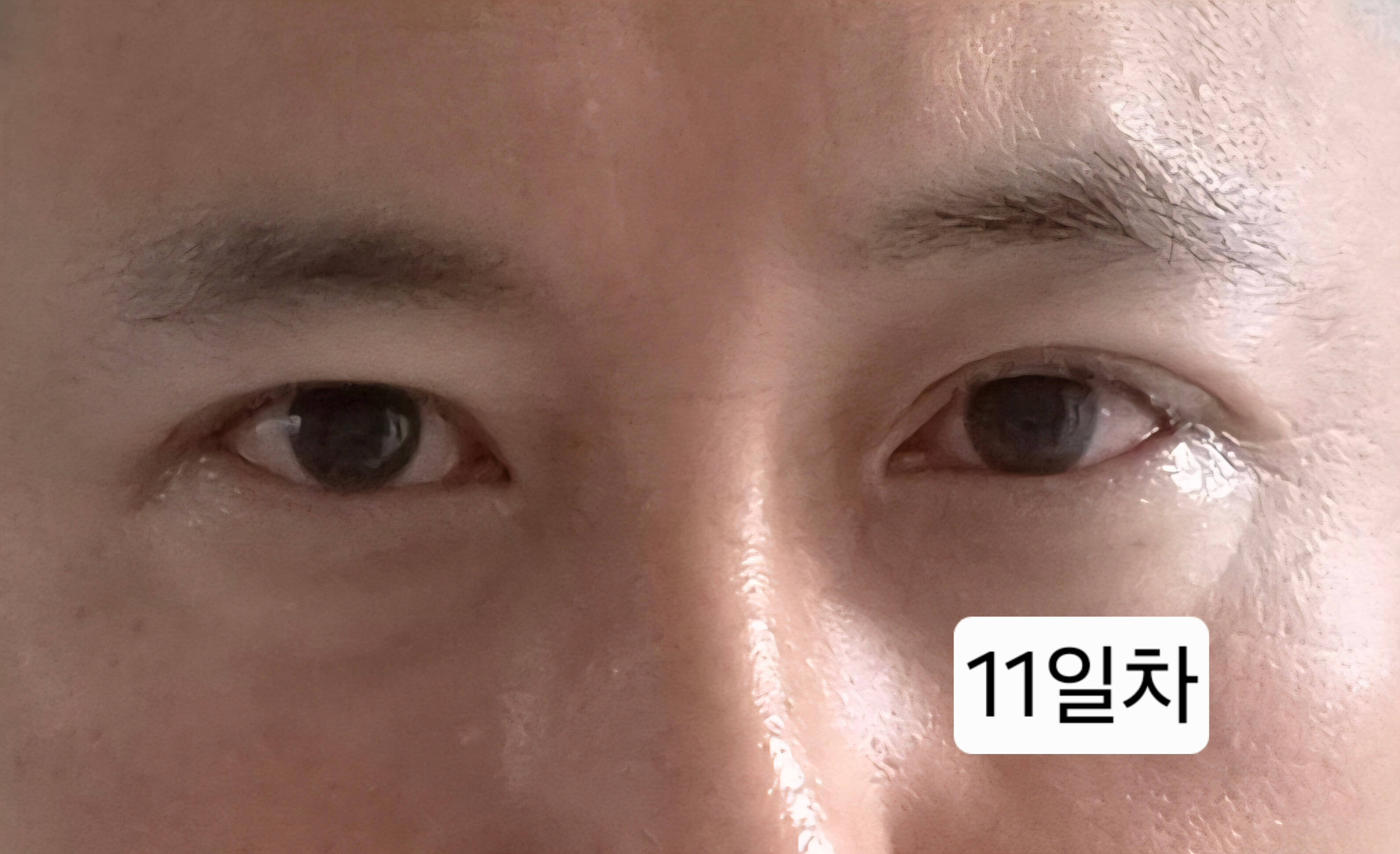 유행성각결막염 눈병 초기증상부터 12일차 치료 기록(진행 중)