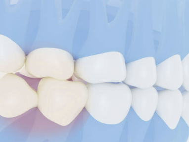 사랑니 발치후 식사 주의사항 가이드