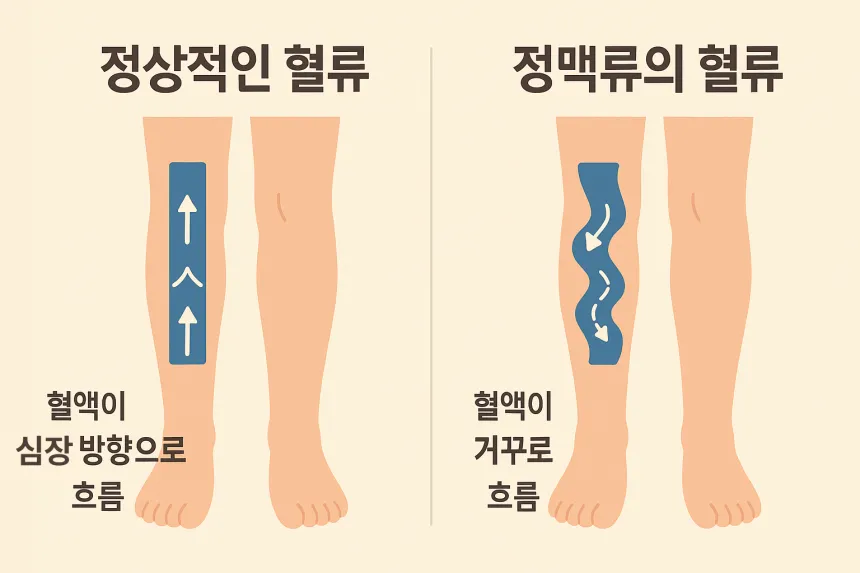 하지 정맥류 증상