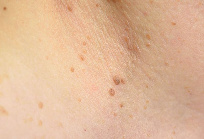 피부에 난 편평사마귀 사진