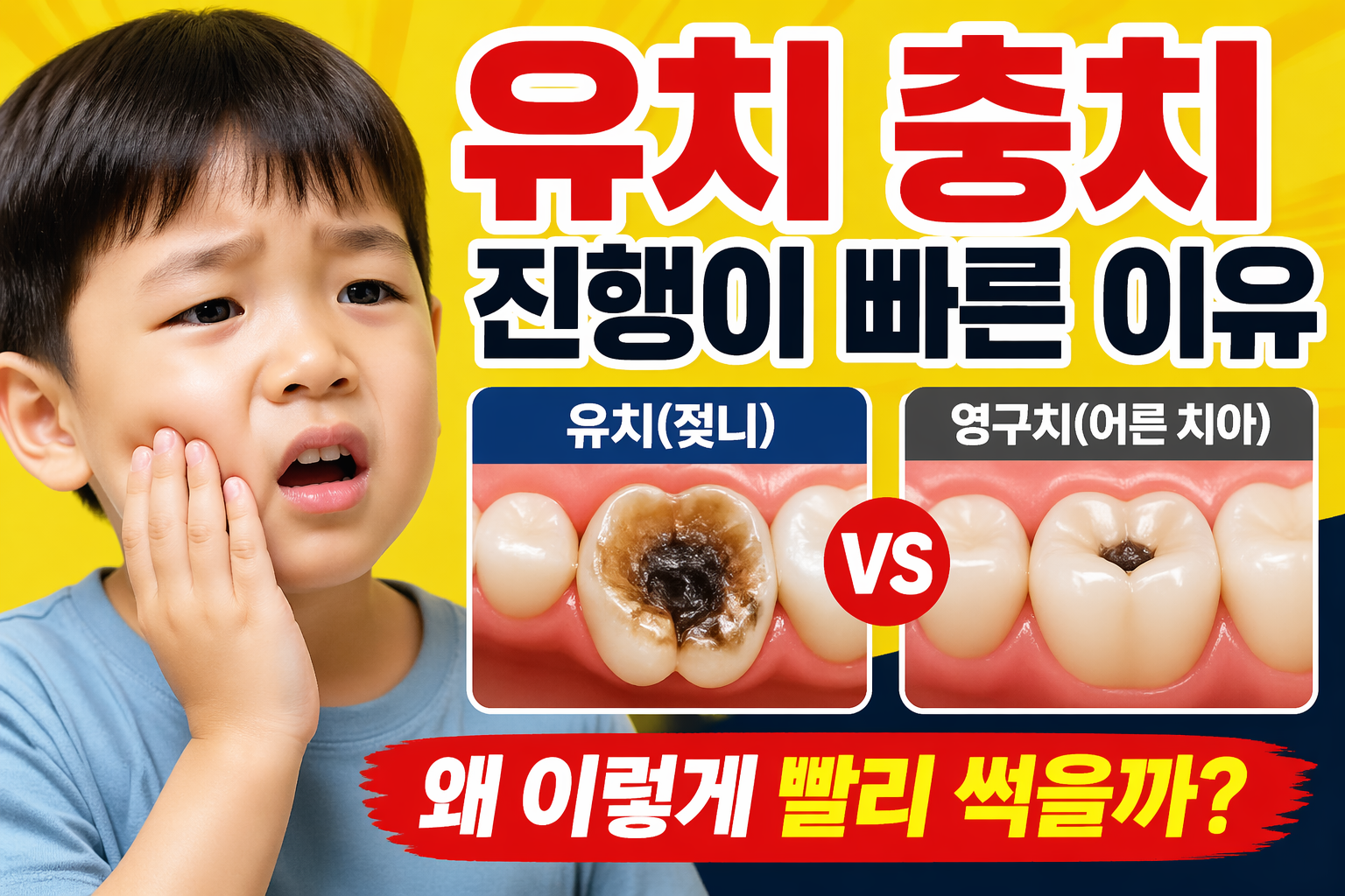 유치충치