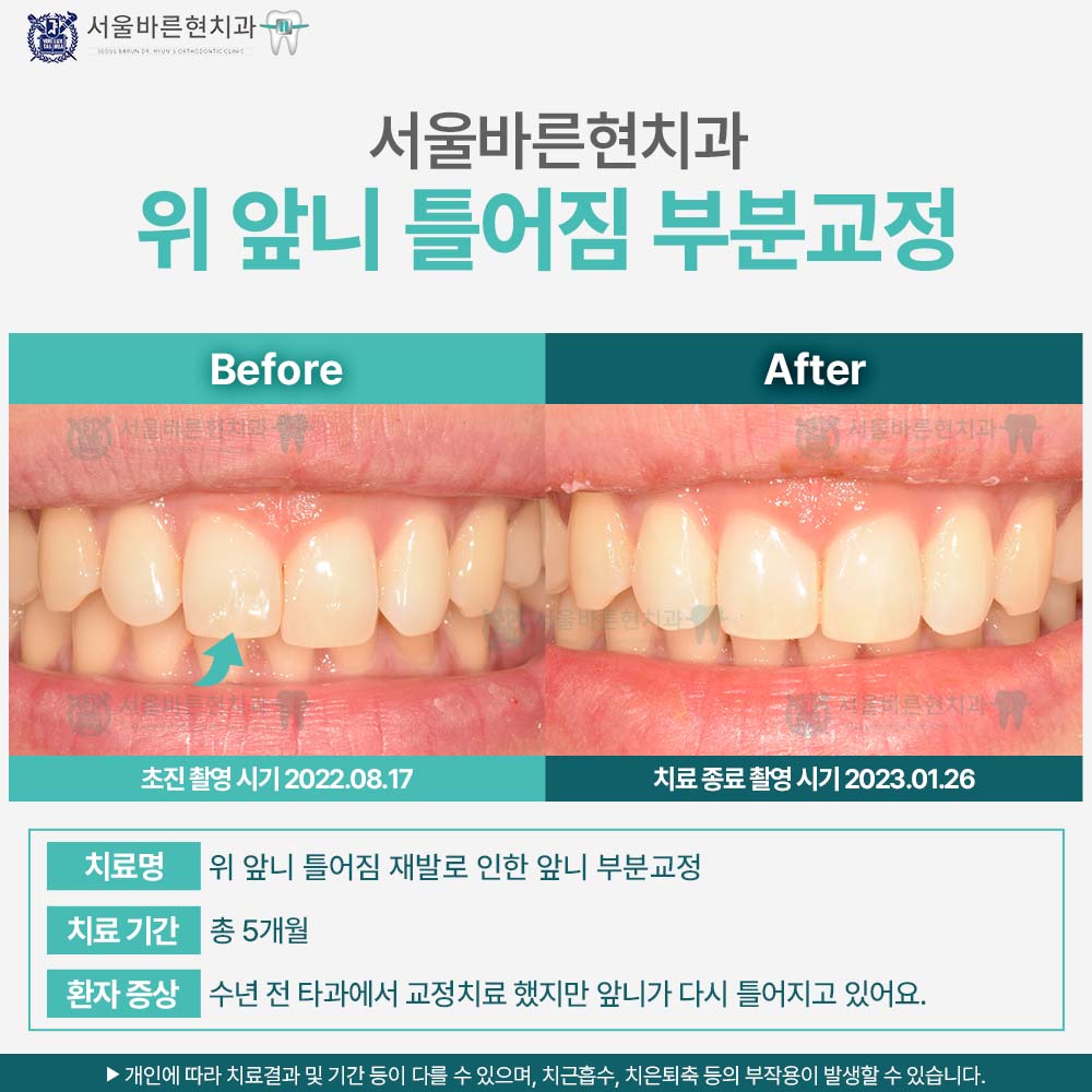 해운대부분교정