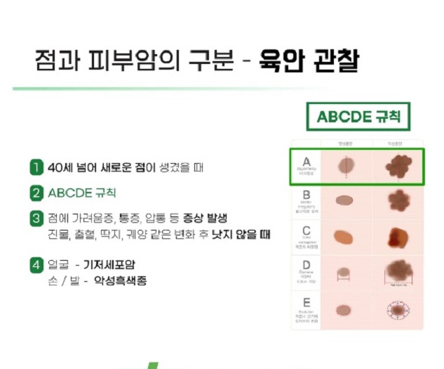 점과피부암구분