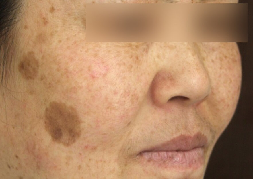 지루각화증 검버섯 홈케어 방법 설명 이미지로 자외선 차단과 비타민C 세럼 사용으로 피부 색소 침착 개선에 도움을 주는 스킨케어 관리법 안내