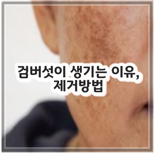검버섯이 생기는 이유, 제거방법
