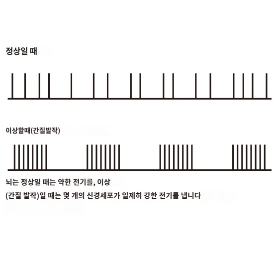 뇌전증 간질