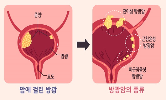 방광암 증상 자가진단