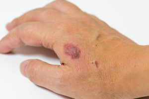 화상이 따끔따끔 아플 때 대처법