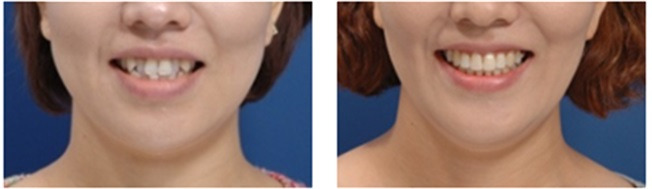 성인 치아교정 전후 비교