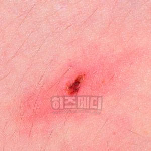 쯔쯔가무시 물린자국