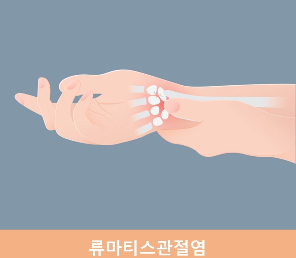 류마티스-관절염