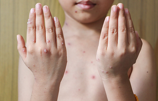 수족구병 증상 원인 치료 전염 수포 잠복기