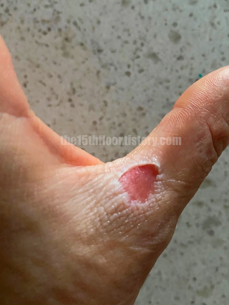 화상 부위와 병원 방문