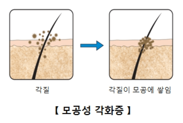 모공각화증