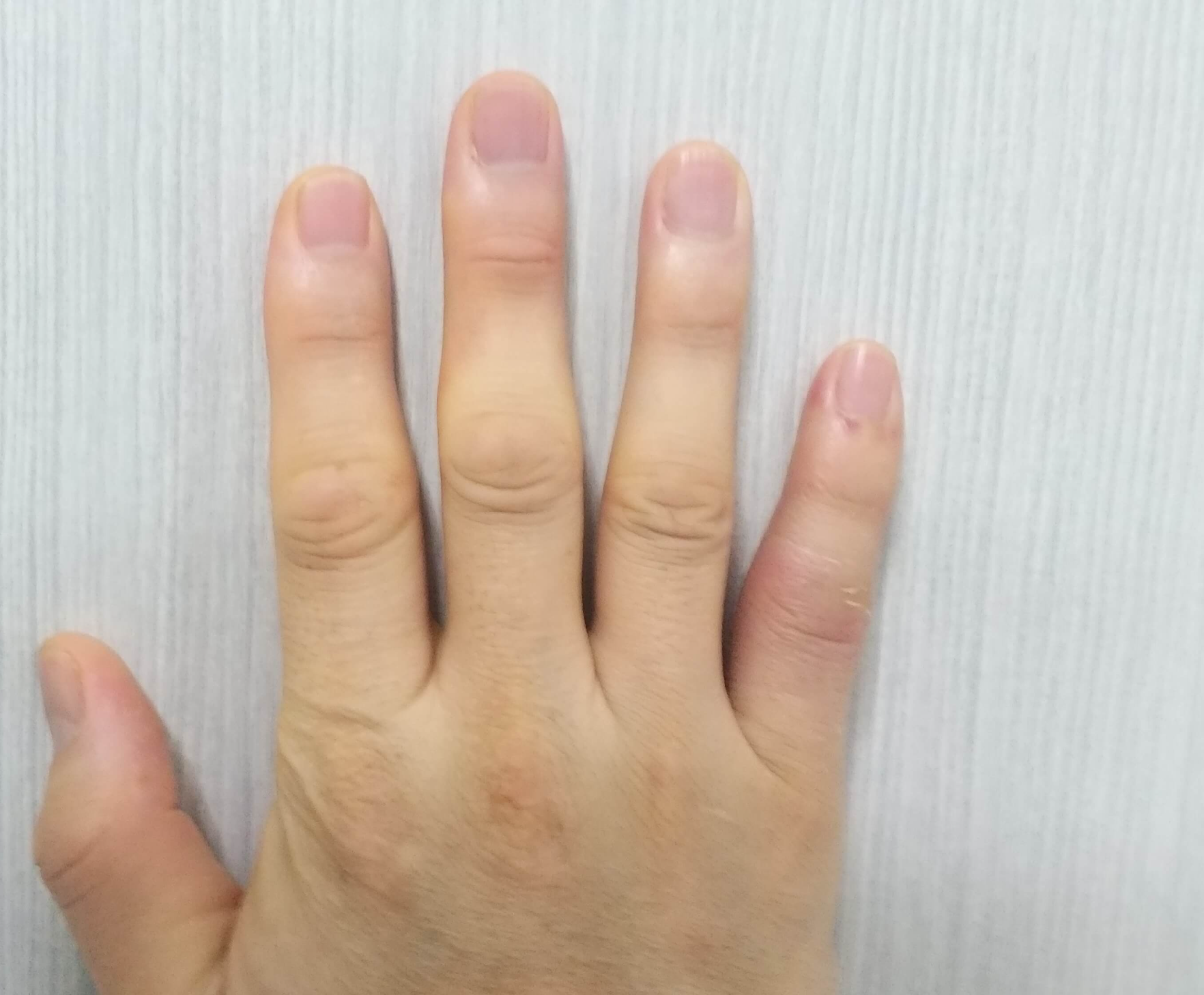 2월13일손가락부은상태사진2