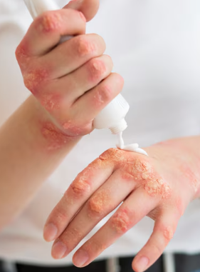 피부 붉은반점 29