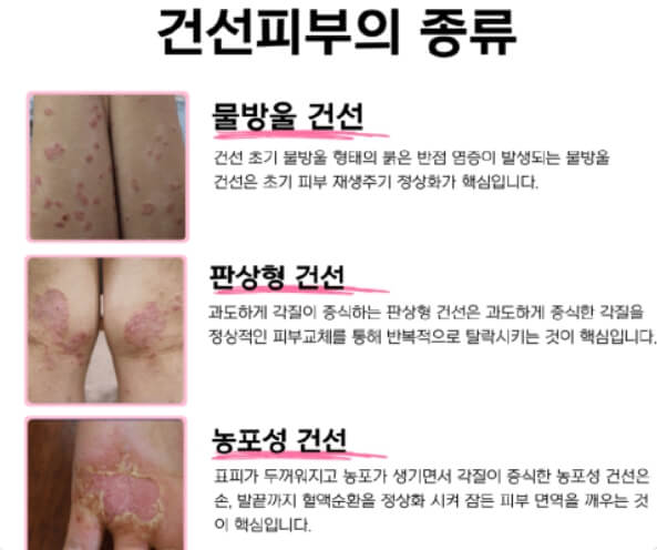 건선의 유형