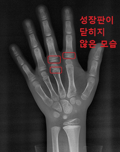 아직 닫히지 않은 성장판 엑스레이