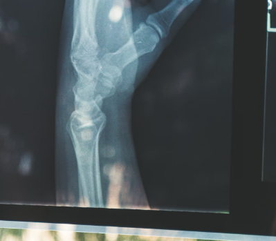 히알루론산 효능