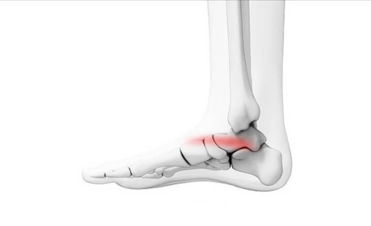 족저근막염 진단 예방 치료 알아보기