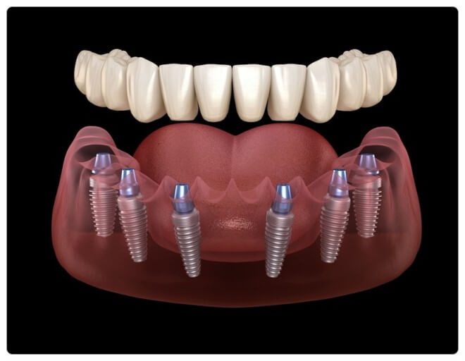 임플란트 보험 임플란트 가격 임플란트 비용 치아 보험 추천 치과 보험 추천 임플란트 치아 보험 치아 보험 적용 기과 보험 적용 치과 보험 임플란트 임플란트 치아