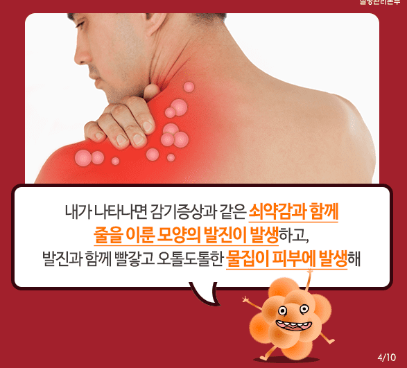 대상포진 감염 증상 안내