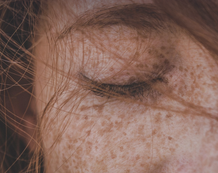 기미 발생 원인과 제거 방법 관련 사진