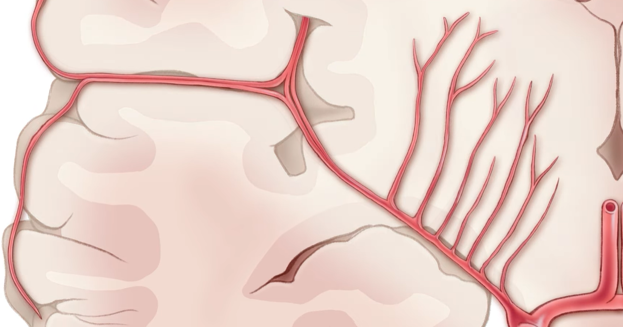 모야모야병 증상