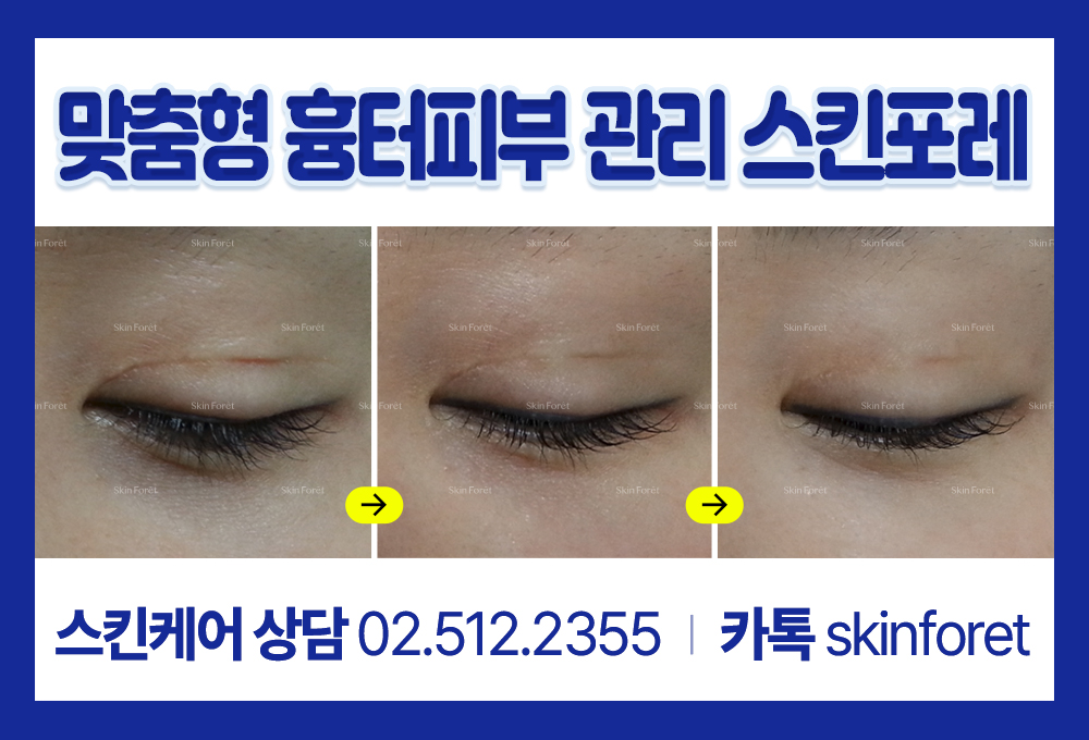 몽고주름과 쌍꺼풀 흉살 관리 과정사진