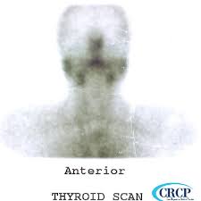 갑상선 기능 저하증