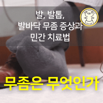발, 발톱, 발바닥 무좀의 증상과 치료 방법 발, 발톱, 발바닥 무좀의 증상과 치료 방법