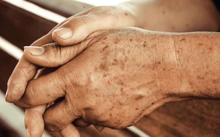 검버섯 없애는 방법 및 검버섯 원인 총정리