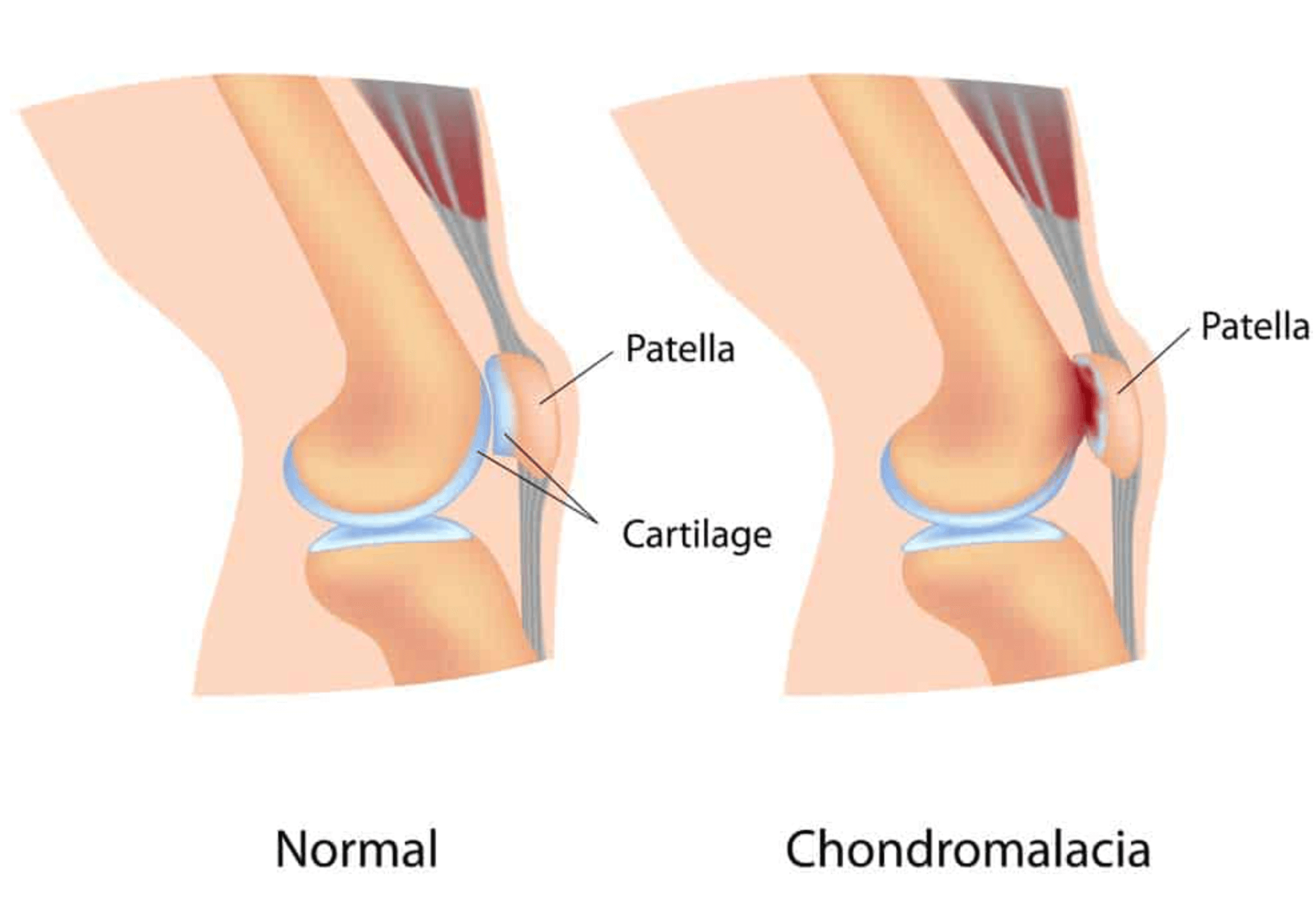 연골연화증 치료