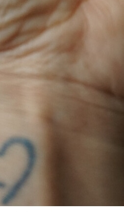 손가락수포대처법