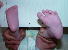 안짱 걸음 출처 대한 정형외과 학회 홈페이지