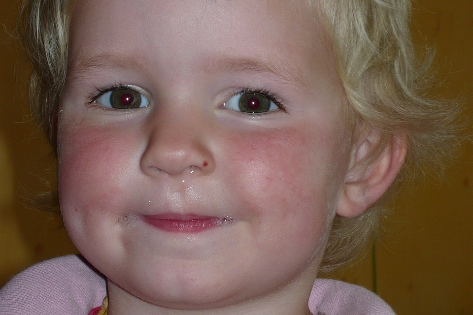 콧물 증상에 따른 아이 건강 상태