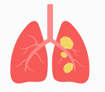 폐암