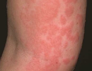 콜린성 두드러기, 두드러기 증상, 열 알러지, 땀 알러지, 두드러기 약, 피부 가려움, 운동 후 두드러기, 여름 피부질환